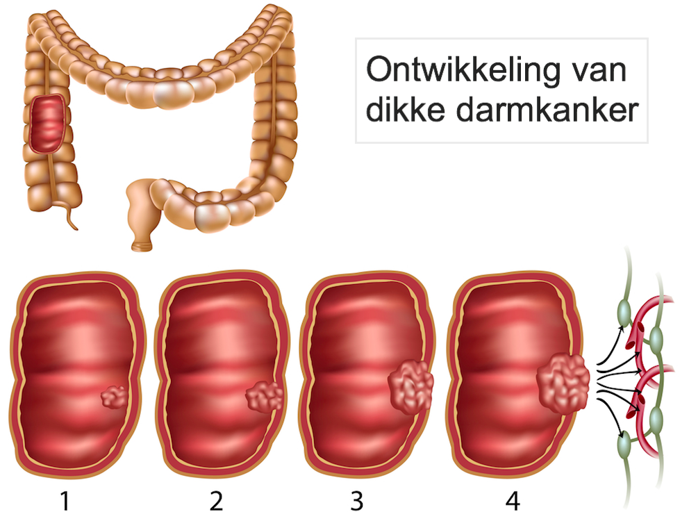 Ontwikkeling darmkanker