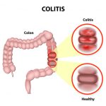 Colitis ulcerosa