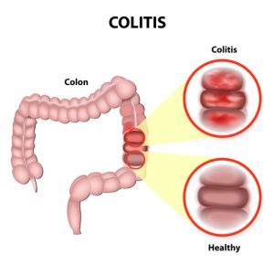 Colitis ulcerosa